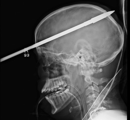 X-Ray of a human head and neck showing a spear that has entered the forehead with the tip of the spear just exiting the back of the skull. This is the sort of thing that does not happen without some negligence.